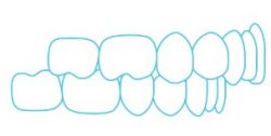 Overbite Overbite