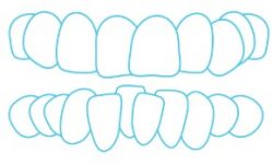 crowded teeth crowded teeth